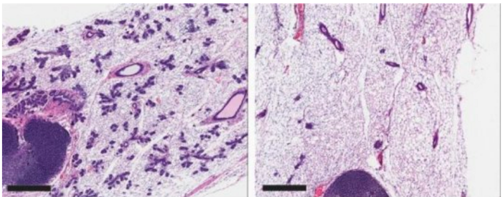 Protein mà các tế bào gốc cần có thể là một mục tiêu trong việc giết các tế bào ung thư vú