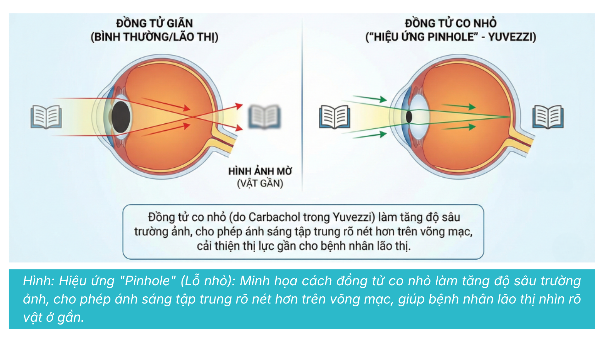 Tenpoint Therapeutics và Yuvezzi: Sự Đổi Mới Dược Lý Trong Nhãn Khoa